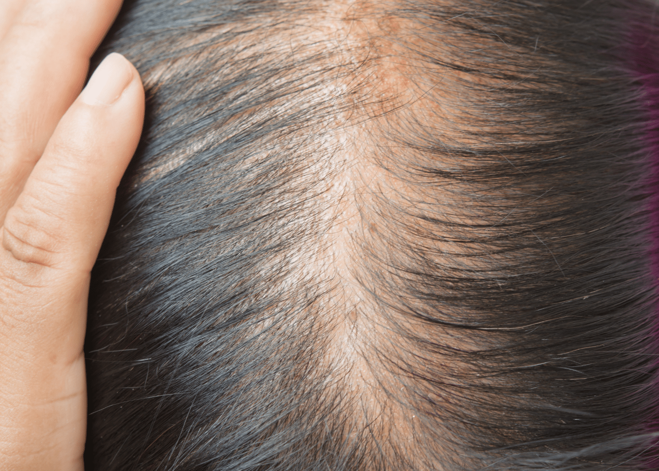 Image of a scalp with fine hair